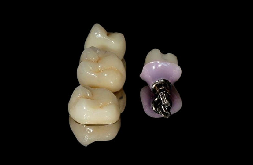 Implant Cemented Crown